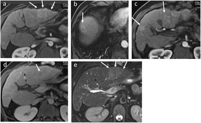 Case Report: Successful liver transplantation after achieving complete clinical remission of advanced HCC with Atezolizumab plus Bevacizumab combination therapy